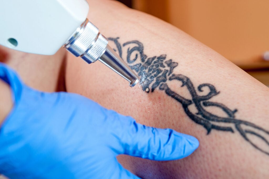 tattoo removal, body, leg,